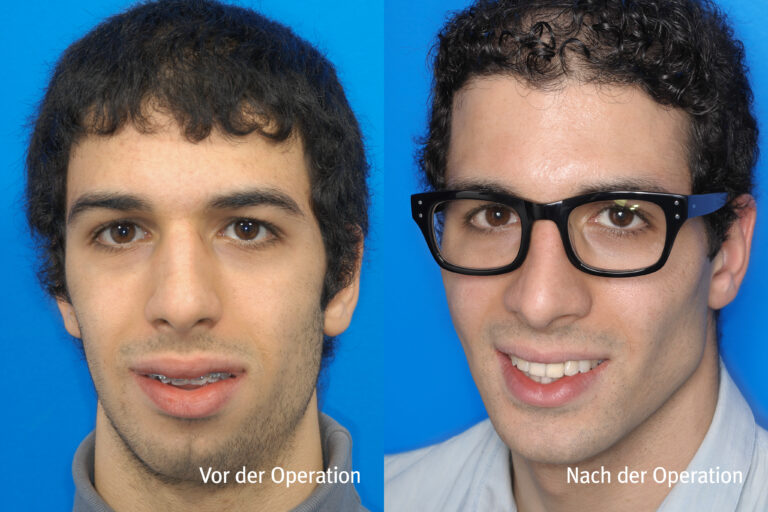 Kieferwinkel – Vorher / Nachher