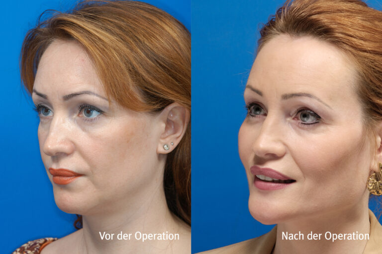 Kieferwinkel – Vorher / Nachher