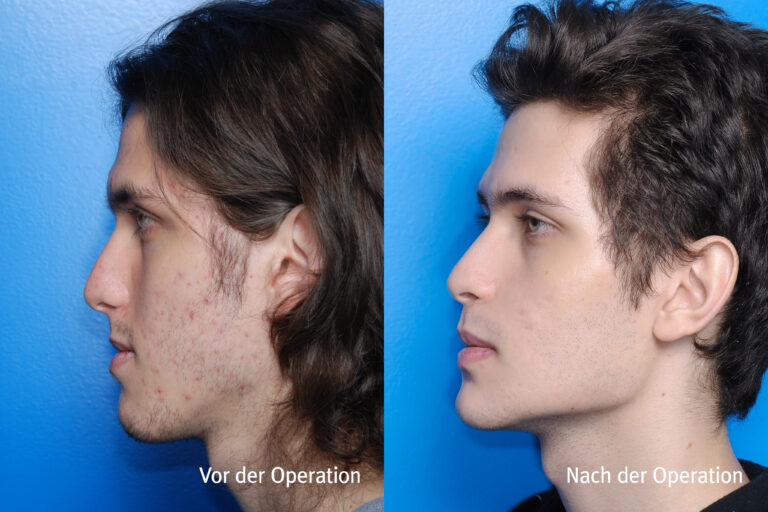 Kieferwinkel – Vorher / Nachher