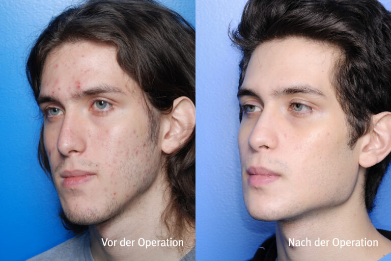 Kieferwinkel – Vorher / Nachher