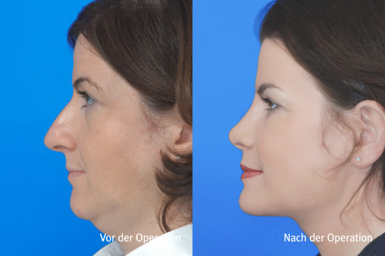 Kieferwinkel – Vorher / Nachher
