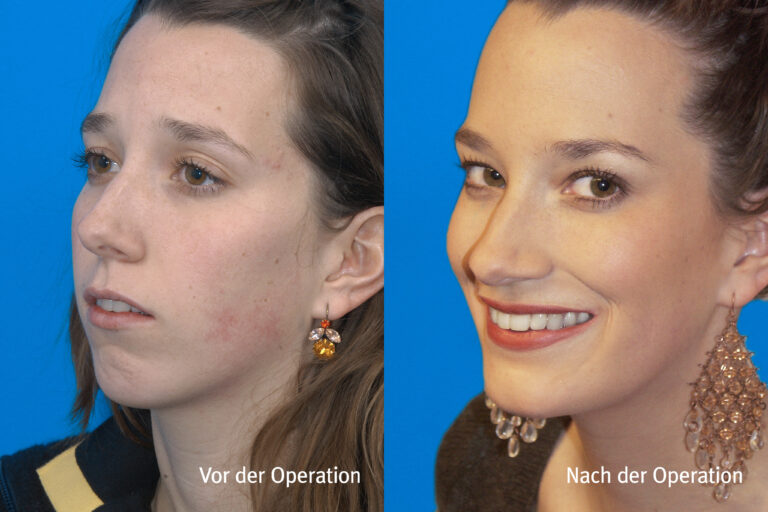 Kieferwinkel – Vorher / Nachher