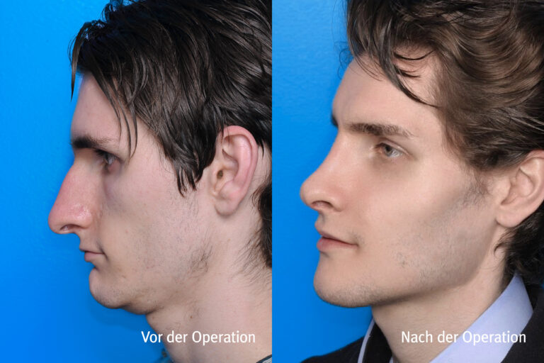 Kieferwinkel – Vorher / Nachher