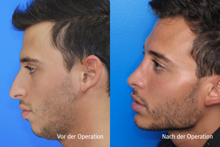 Kieferwinkel – Vorher / Nachher