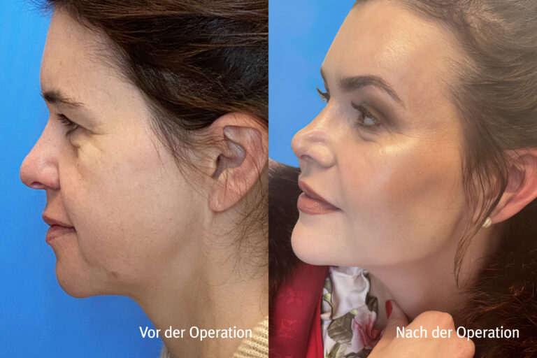 Kieferwinkel – Vorher / Nachher