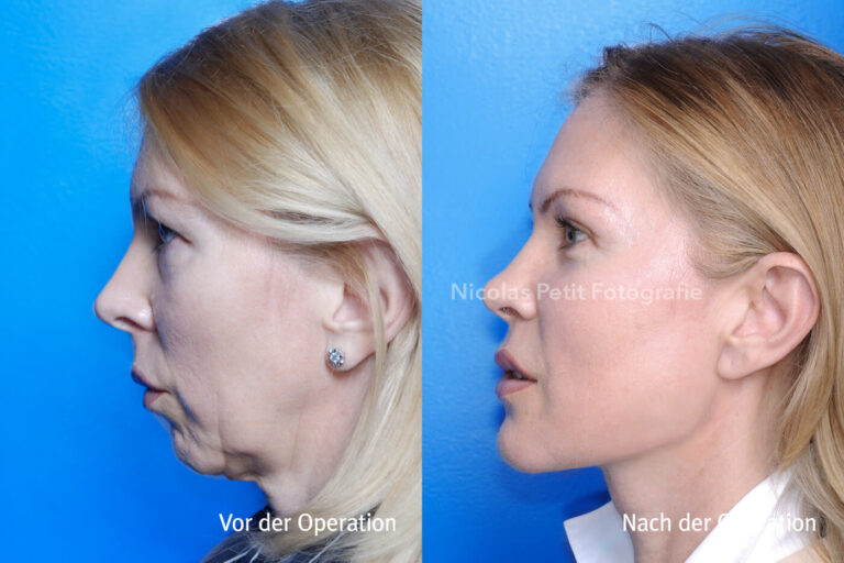 Kinnkorrekturen – Vorher / Nachher