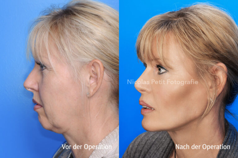 Kinnkorrekturen – Vorher / Nachher