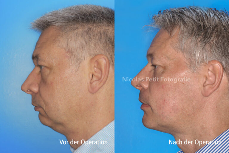 Kinnkorrekturen – Vorher / Nachher