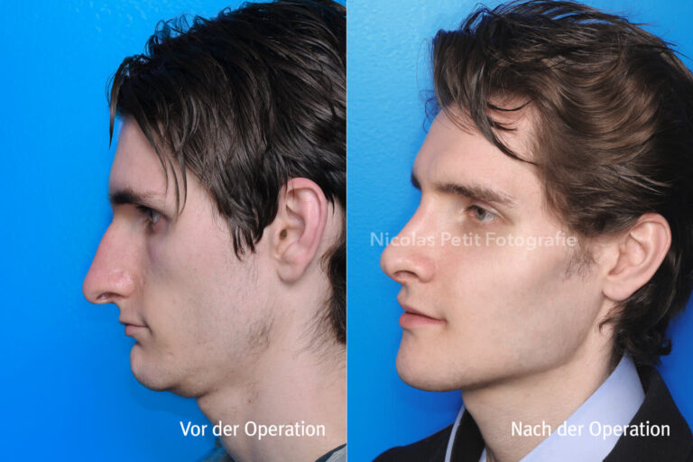 Kinnkorrekturen – Vorher / Nachher