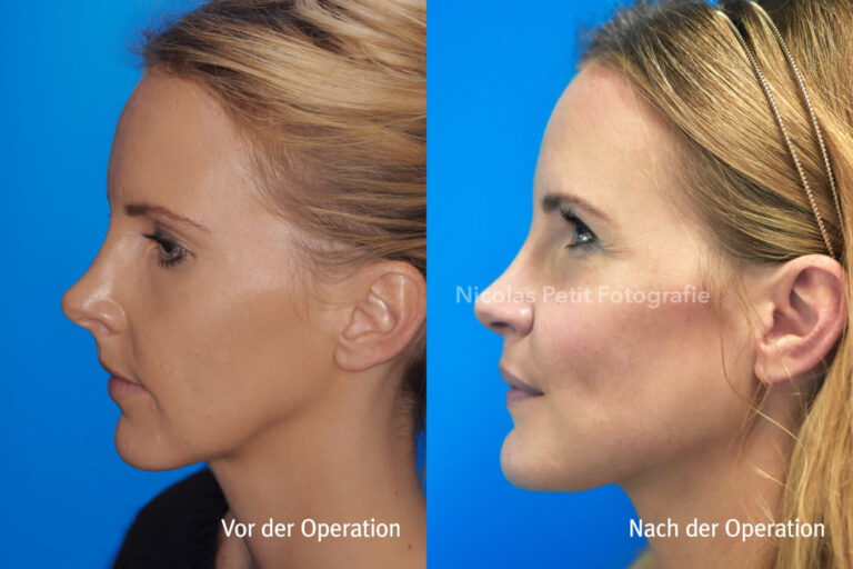 Kinnkorrekturen – Vorher / Nachher
