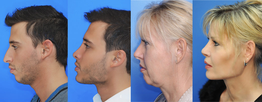 Ästhetische Schönheitschirurgie Beispielbilder